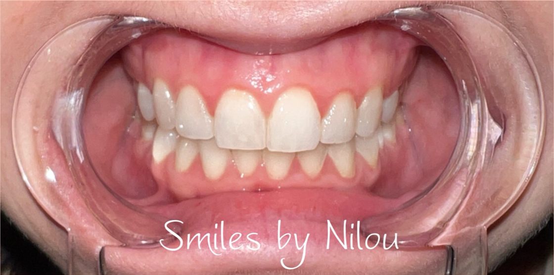 A client's teeth after a whitening session with Smiles by Nilou