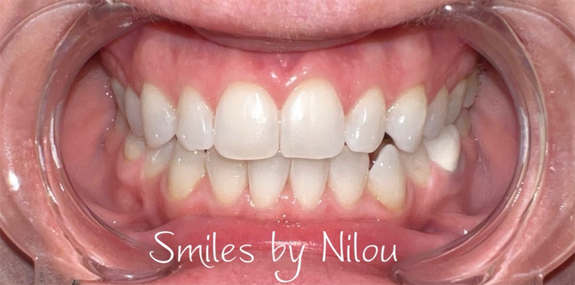 A client's teeth after a whitening session with Smiles by Nilou
