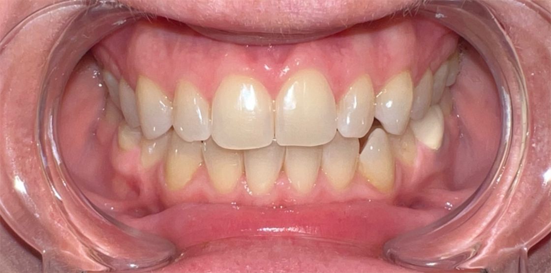 The same client's teeth before the session