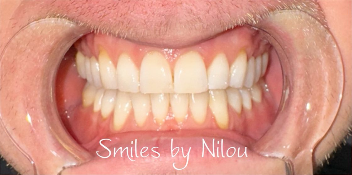 A client's teeth after a whitening session with Smiles by Nilou