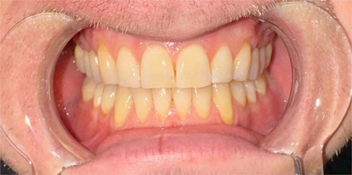 The same client's teeth before the session