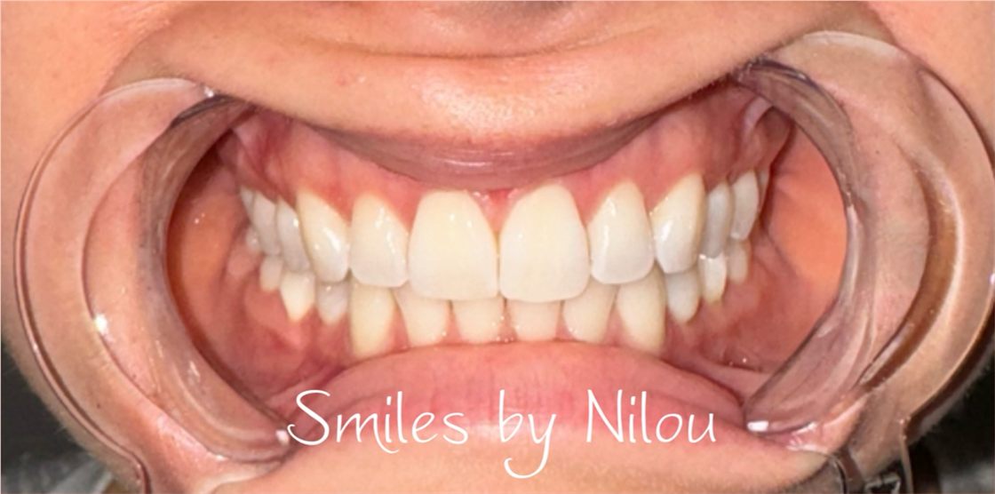 A client's teeth after a whitening session with Smiles by Nilou