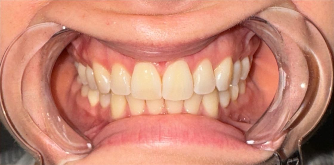 The same client's teeth before the session